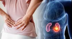 50% of patients with kidney stones end up with some degree of kidney failure