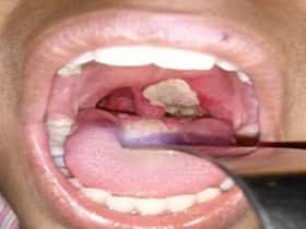 Diphtheria: Antimicrobial resistance may trigger resurgence of this disease as major global health threat Diphtheria: Antimicrobial resistance may trigger resurgence of this disease as major global health threat