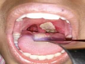 Diphtheria: Antimicrobial resistance may trigger resurgence of this disease as major global health threat