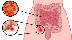 33-year-old man with a rare cancer of the appendix and small intestine, gets second lease of life