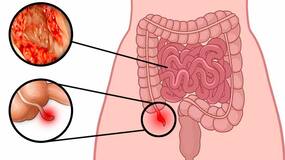 33-year-old man with a rare cancer of the appendix and small intestine, gets second lease of life