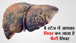 4 स्टेज में होता है फैटी लिवर! जानें कौन सी स्थिति में आपके लिवर को पहुंचता है सबसे ज्यादा नुकसान और कैसे बचें