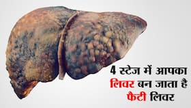 4 स्टेज में होता है फैटी लिवर! जानें कौन सी स्थिति में आपके लिवर को पहुंचता है सबसे ज्यादा नुकसान और कैसे बचें 4 स्टेज में होता है फैटी लिवर! जानें कौन सी स्थिति में आपके लिवर को पहुंचता है सबसे ज्यादा नुकसान और कैसे बचें