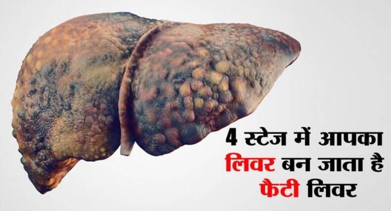 4 स्टेज में होता है फैटी लिवर! जानें कौन सी स्थिति में आपके लिवर को पहुंचता है सबसे ज्यादा नुकसान और कैसे बचें