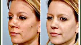 How to remove moles in hindi: 3 से 5 रुपये में मिलने वाली इन 4 चीजों से हटाएं चेहरे के तिल, जानें तिल को हटाने का सबसे सस्ता तरीका