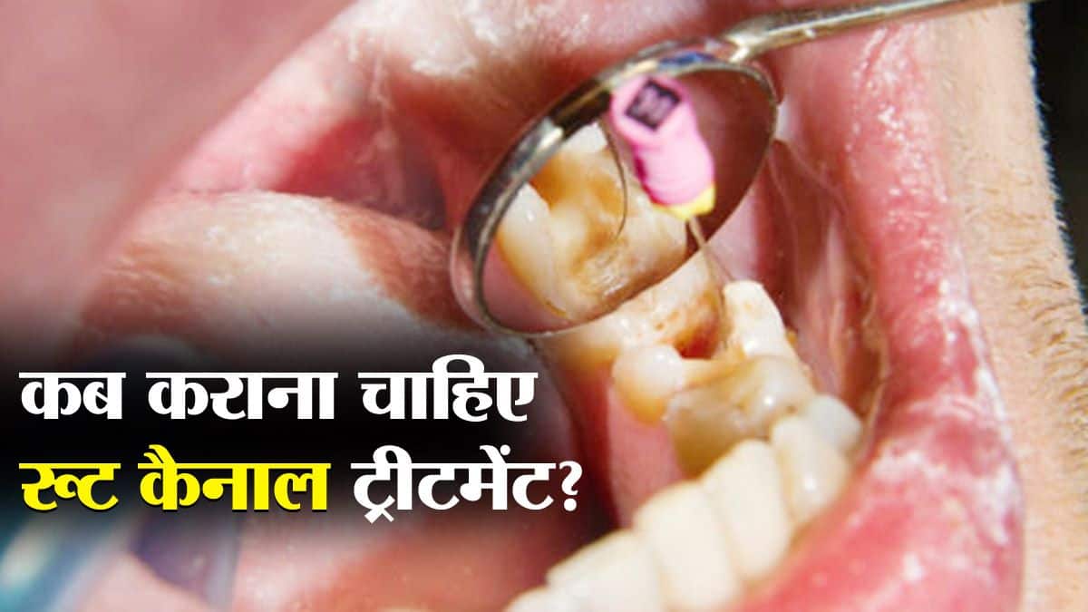 कब कराना चाहिए रूट कैनाल ट्रीटमेंट? इन 3 स्थितियों में ही कराएं रूट