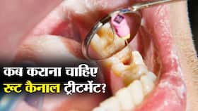 कब कराना चाहिए रूट कैनाल ट्रीटमेंट? इन 3 स्थितियों में ही कराएं रूट कैनाल ट्रीटमेंट नहीं तो हो जाएंगे परेशान