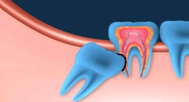 Akkal dadh pain : 17 से 25 की उम्र में आए अक्कल दाढ़ तो चबाएं लौंग के ...