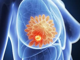 Breast Cancer Treatment: New 5-Minute Therapy Can Effectively Reduce The Symptoms