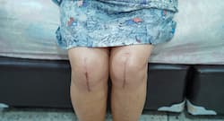 Rheumatoid arthritis: Woman Bedridden For 9 Years Walks Again After 3D Roboalign TKR surgery