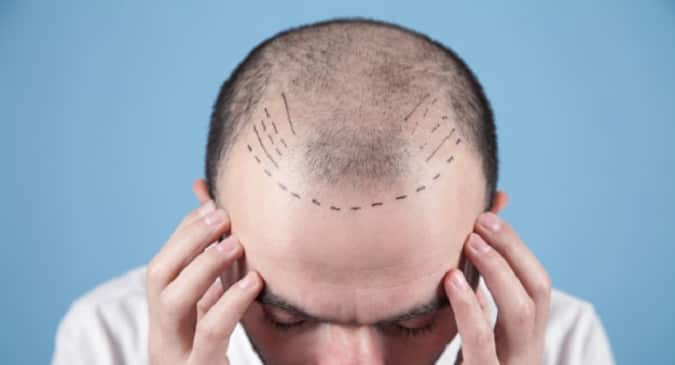 Best time for hair transplant: Here's what expert says 