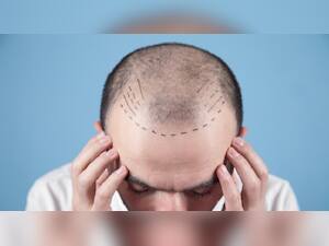 The Rising Trend Of Hair Transplantation: India's Emergence As A Global Hub