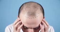 Summer or Winter: Which Season is Best for Hair Transplant?
