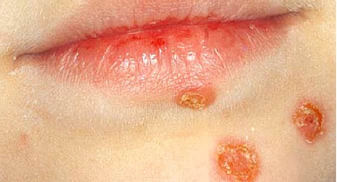 impetigo in adults legs