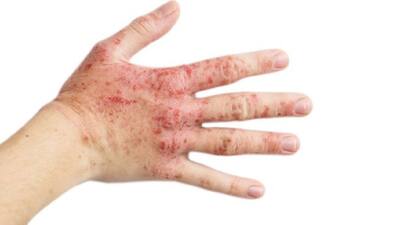 Atopic dermatitis: Understanding the itch that refuses to disappear ...