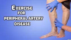 High-intensity exercise beneficial for people with peripheral artery disease