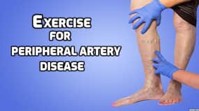 High-intensity exercise beneficial for people with peripheral artery disease