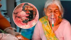 Black Fungus in Corona Patient: ब्‍लैक फंगस के कारण, लक्षण, बचाव और इलाज