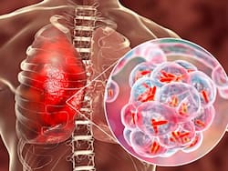Women With COVID-19 Pneumonia At Higher Risk Of Lung Damage: Lancet