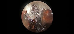 Diabetics At High Risk Of Mucormycosis: How to Avoid Fungus Settling In The Nose