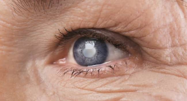 cataracts