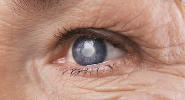 cataracts
