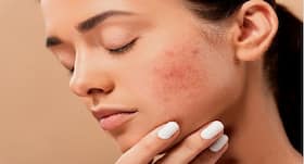 What Do You Need To Know About Skin Purging