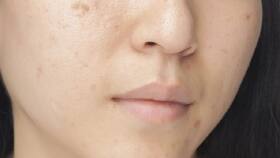 Flaunt A Blemish-Free Skin: Remove Acne Scars The Natural Way