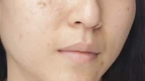 4 Affordable Home Remedies For Acne-Prone Skin