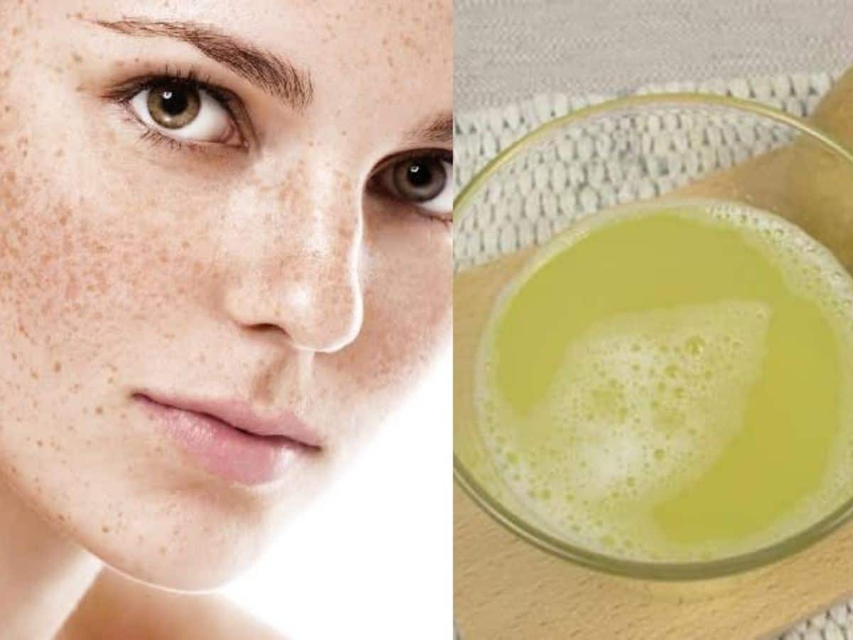 Pigmentation (Jhaiya) On Face चेहरे से झाइयां और दागधब्‍बे हटाने के