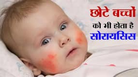 Psoriasis in Chidren: 5 साल से छोटे बच्‍चों में ऐसे दिखते हैं सोरायसिस के लक्षण