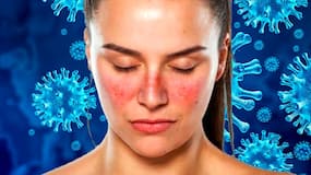 World Lupus Day: People With This Autoimmune Disorder Are At Higher Risk Of Covid-19