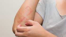 Dermatitis Reported In 2/3rd Population: Know How It Is Connected With Covid-19