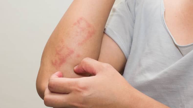 dermatitis