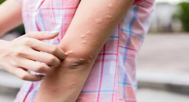 can glutathione cause hives Hives: Here's All You Need To Know About The Infection