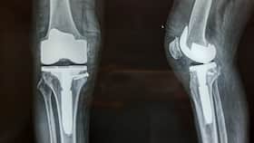 5 Advantages Of Robotic Knee Replacement Surgery