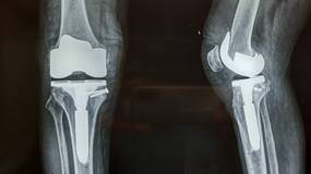 5 Advantages Of Robotic Knee Replacement Surgery