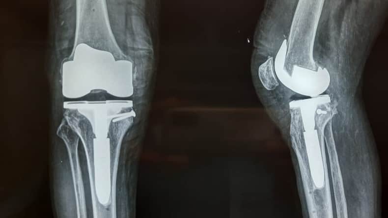 Arthroplasty: All About This Knee Replacement Surgery