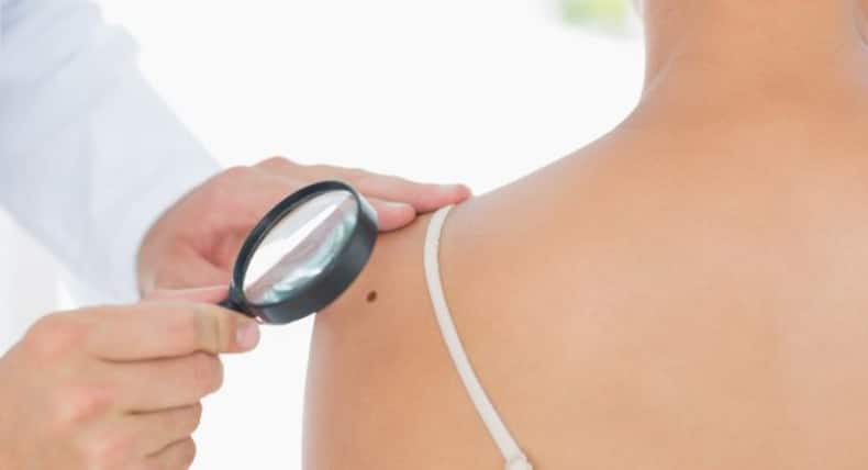 5 Unexpected Spots Where You Can Develop Skin Cancer