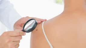 5 Unexpected Spots Where You Can Develop Skin Cancer