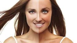 सनबर्न को दूर करने के लिए घरेलू नुस्खे