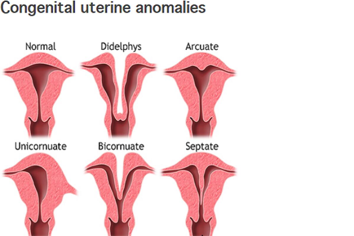 11++ Abnormal uterus and miscarriage risk ideas