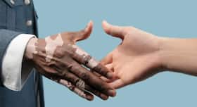 Can Homoeopathy Help In Treating Leukoderma? Explains Dr Banerjee Can Homoeopathy Help In Treating Leukoderma? Explains Dr Banerjee
