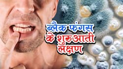 Black Fungus: ब्‍लैक फंगस होने पर दांतों में दिखता है सबसे पहला लक्षण