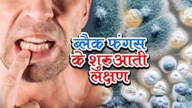Black Fungus: ब्‍लैक फंगस होने पर दांतों में दिखता है सबसे पहला लक्षण