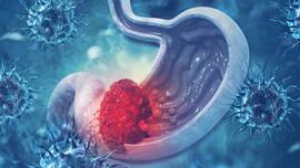 Stomach Cancer Awareness Month: How To Minimize The Risk Of Gastric Cancer?