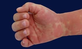 Post-COVID Inflammatory Syndrome Rare But Possible In Adults: Symptoms To Look Out For
