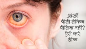 Home remedies to improve your eyes brightness : पीलिया नहीं है फिर भी आंखें रहती है पीली?