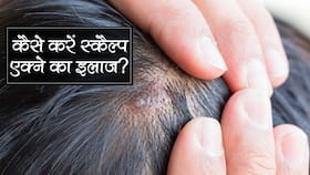 How to treat Scalp Acne in hindi : डैंड्रफ से होने वाले स्कैल्प एक्ने से कैसे पाए राहत? How to treat Scalp Acne in hindi : डैंड्रफ से होने वाले स्कैल्प एक्ने से कैसे पाए राहत?