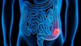 Stop Eating A High-Fat Diet; It May Increase Your Risk Of Intestinal And Colon Cancer